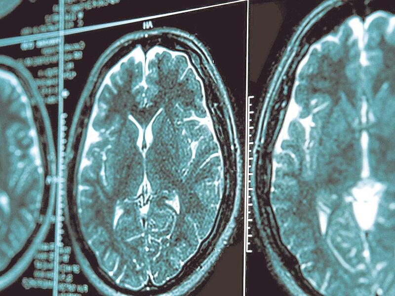 Bei einer Parkinson-Erkrankung verklumpt Eiwei&szlig; im Mittelhirn. Dadurch werden Gehirnzellen gesch&auml;digt und sterben ab &ndash; der dadurch entstehende Dopamin-Mangel f&uuml;hrt zu motorischen St&ouml;rungen.