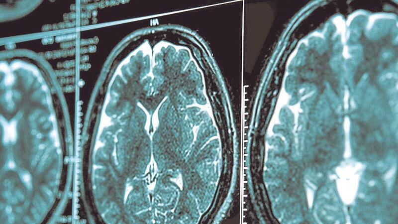 Bei einer Parkinson-Erkrankung verklumpt Eiwei&szlig; im Mittelhirn. Dadurch werden Gehirnzellen gesch&auml;digt und sterben ab &ndash; der dadurch entstehende Dopamin-Mangel f&uuml;hrt zu motorischen St&ouml;rungen.