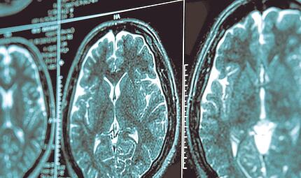 Bei einer Parkinson-Erkrankung verklumpt Eiwei&szlig; im Mittelhirn. Dadurch werden Gehirnzellen gesch&auml;digt und sterben ab &ndash; der dadurch entstehende Dopamin-Mangel f&uuml;hrt zu motorischen St&ouml;rungen.