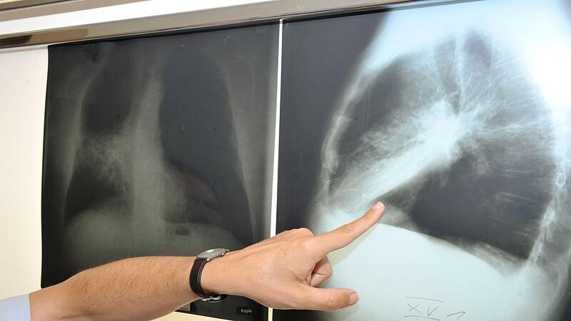 Lungenkrebs Lungenkrebs