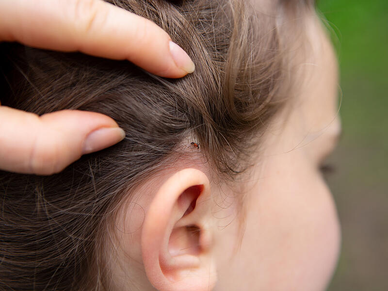 Zecken k&ouml;nnen bei Kindern leicht &uuml;bersehen werden.