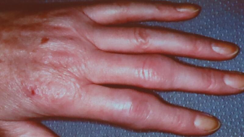 Foto aus der Pr&auml;sentation von Dr. G&uuml;nthel: Beim entz&uuml;ndlichen Rheuma sind die Finger schmerzhaft geschwollen, die Verdickungen an den Gelenken lassen sich eindr&uuml;cken.
