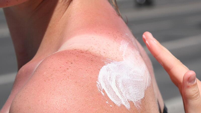 Eine Frau trägt Creme auf einen Sonnenbrand auf Eine Frau trägt Creme auf einen Sonnenbrand auf
