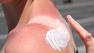 Eine Frau trägt Creme auf einen Sonnenbrand auf Eine Frau trägt Creme auf einen Sonnenbrand auf