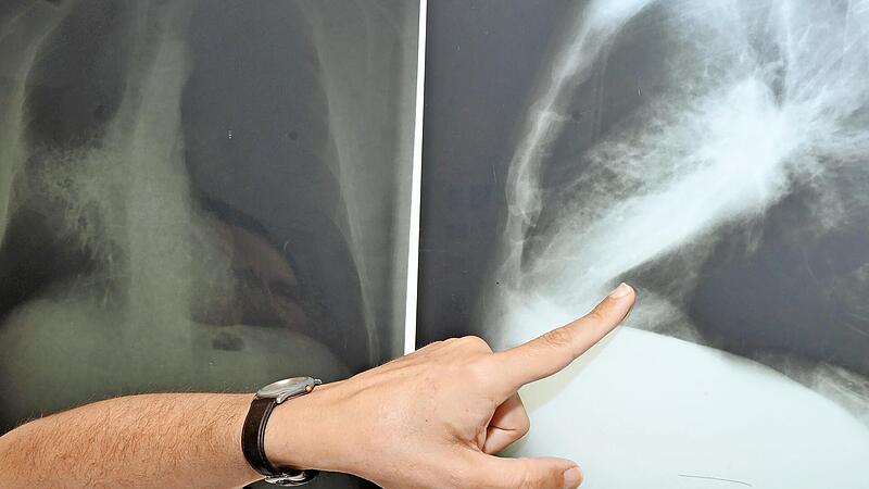 Lungenkrebs trifft immer &ouml;fter auch Frauen und sei l&auml;ngst keine reine M&auml;nnererkrankung mehr, hei&szlig;t es am Thoraxzentrum Bezirk Unterfranken.