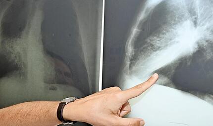 Lungenkrebs trifft immer &ouml;fter auch Frauen und sei l&auml;ngst keine reine M&auml;nnererkrankung mehr, hei&szlig;t es am Thoraxzentrum Bezirk Unterfranken.