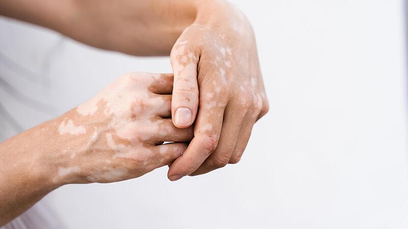 Vitiligo zeigt sich mit wei&szlig;en Flecken auf der Haut und kann in jedem Alter ausbrechen.