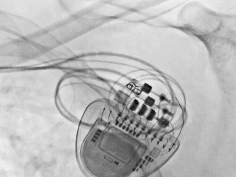 Das Schittmachersystem sitzt an der richtigen Stelle, alle Verbindungen sind korrekt gelegt, wie das Bild zeigt.